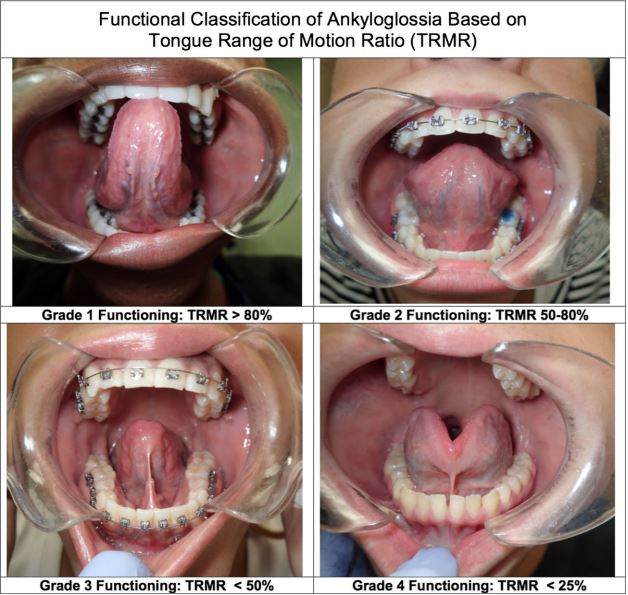 no frenulum tongue