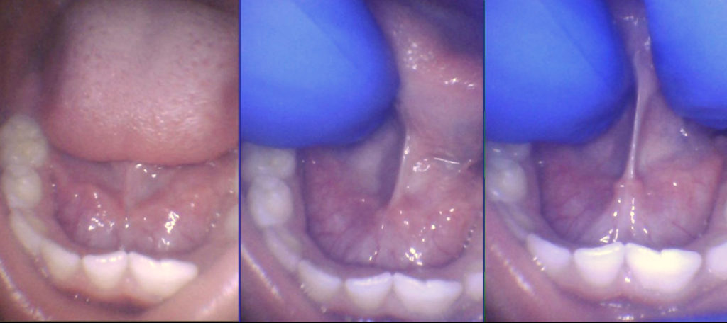 diagnosing a posterior tongue tie