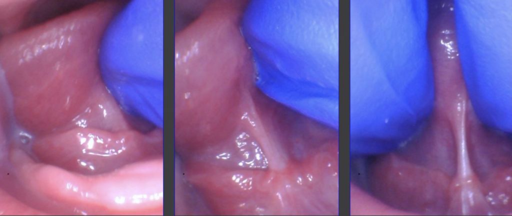 Posterior tongue tie in infant