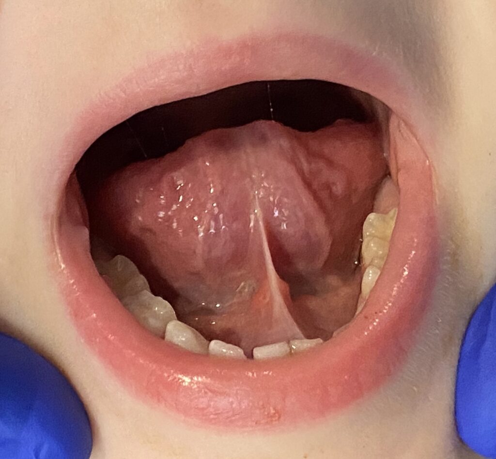 Posterior Tongue Tie