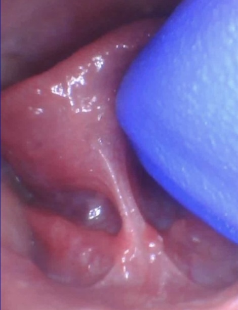 posterior tongue tie dr richard baxter