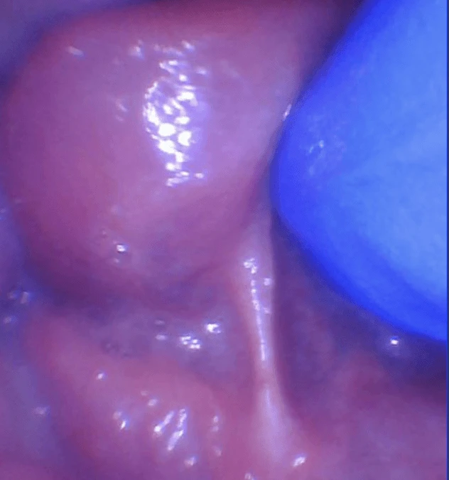 Tongue-Tie vs. Symptomatic Tongue Restriction