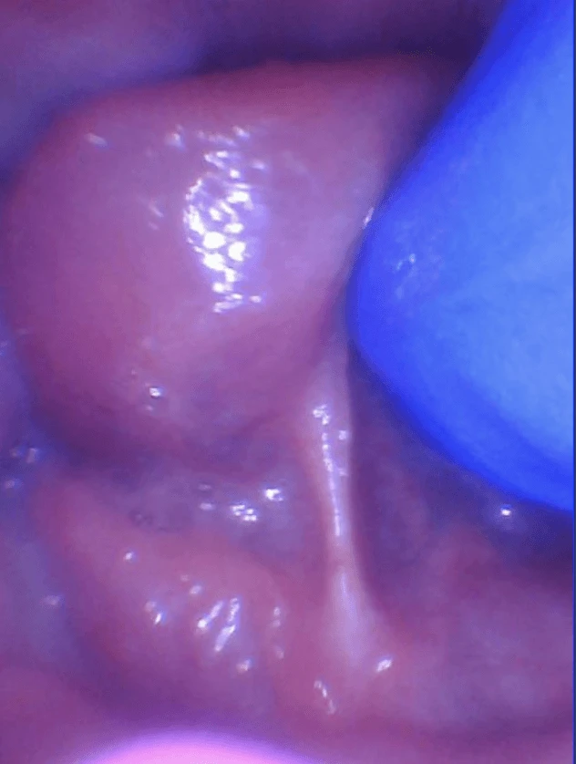 Symptomatic tongue restriction