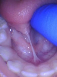 tongue tie min tongue tie min