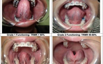Do Tongue-Ties Affect Adults? What Symptoms Do They Have?