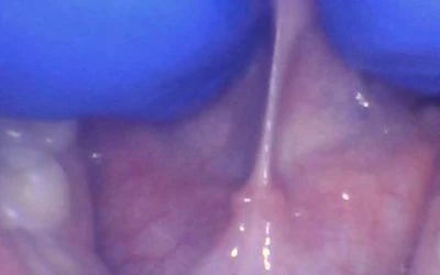 What is a “Posterior Tongue-Tie”?