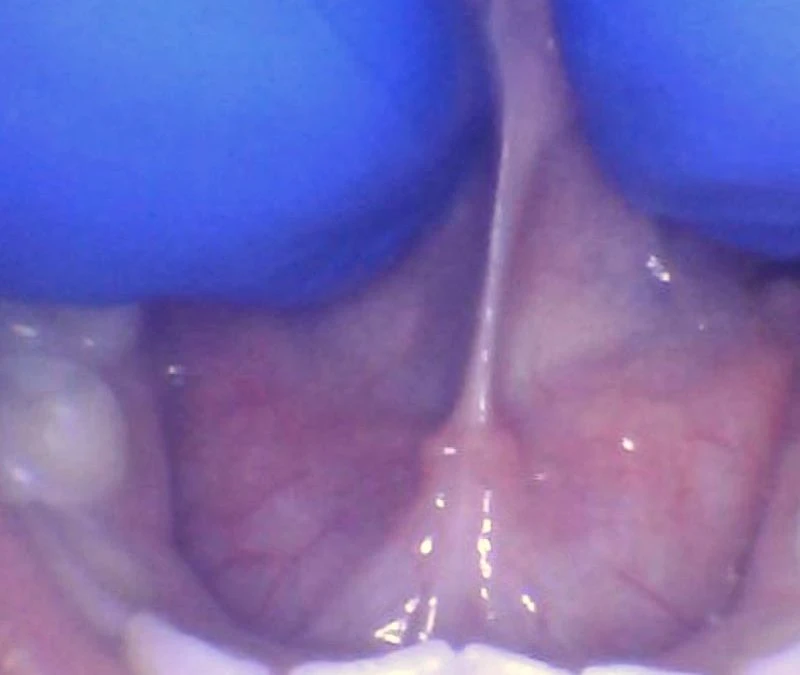 What is a “Posterior Tongue-Tie”?