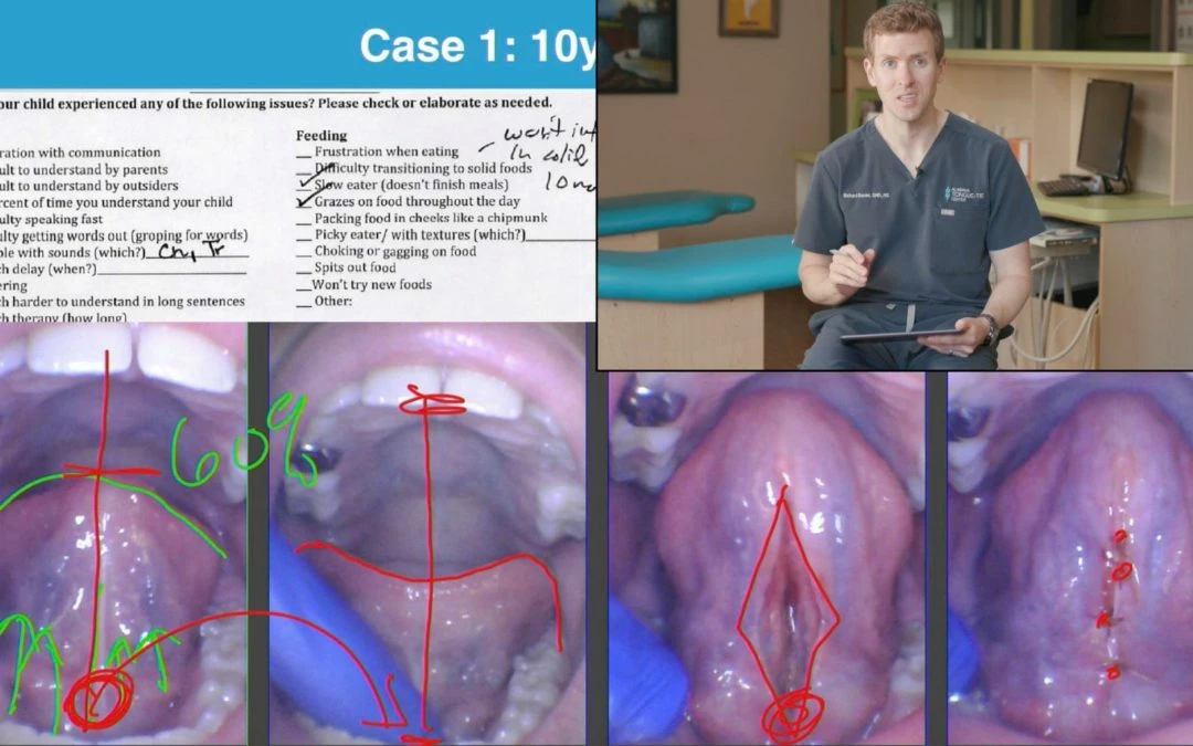 How Do You Treat a Tongue-Tie Properly?