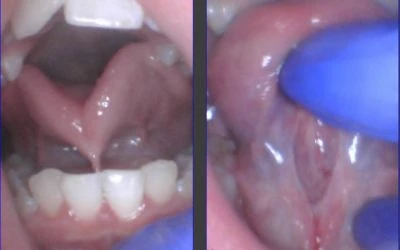 What’s the Best Tool to Use to Treat a Tongue-Tie?