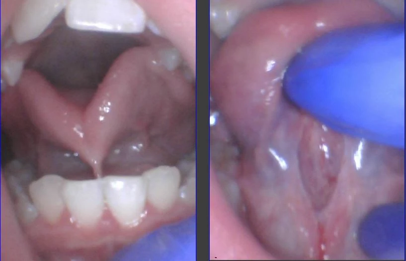 What’s the Best Tool to Use to Treat a Tongue-Tie?