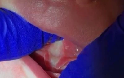 Are Stretches or Exercises Necessary After a Tongue-Tie Release?