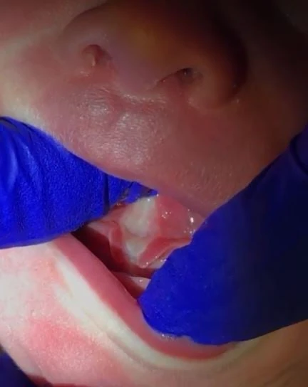 Are Stretches or Exercises Necessary After a Tongue-Tie Release?