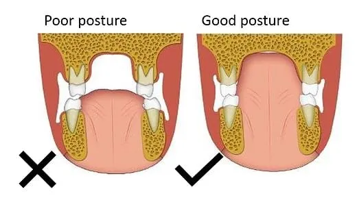 Is Your Tongue Resting On Your Palate?