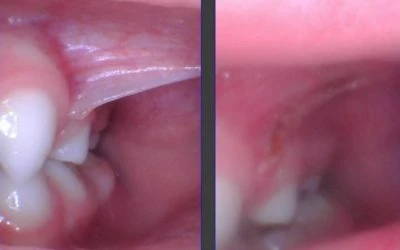 What is a Buccal Tie or Cheek Tie?