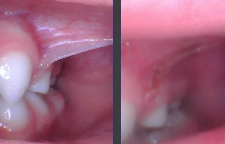 What is a Buccal Tie or Cheek Tie?
