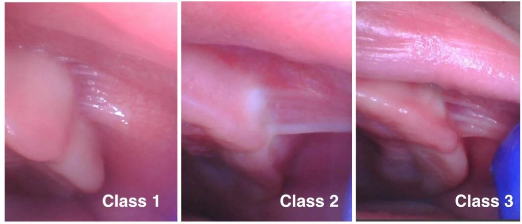 Baxter Buccal Tie Classification Photo Figure