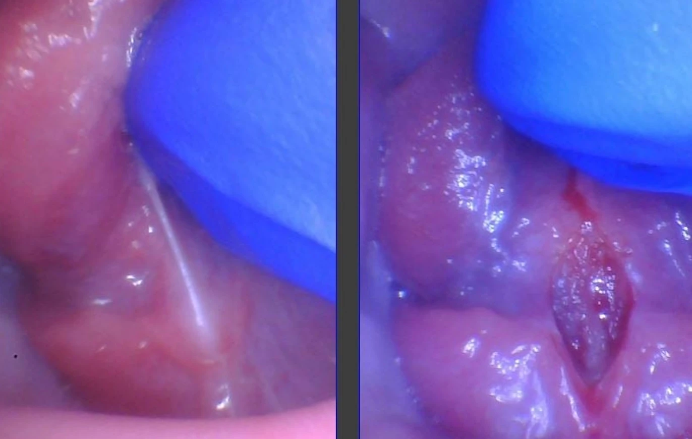 posterior tongue tie release