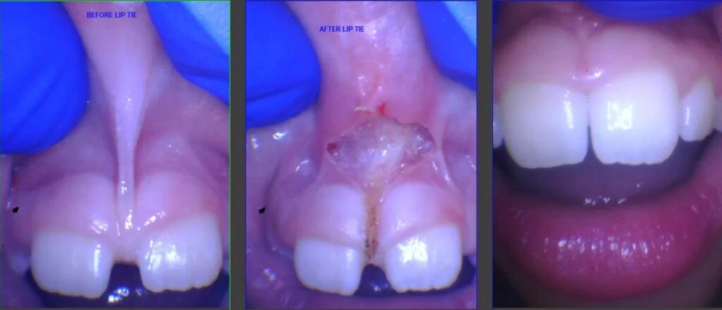 Diastema Closure Permanent Teeth