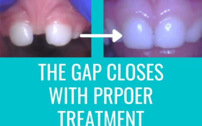 Does Treating a Lip Tie Help Close a Gap in the Teeth? And other common questions.