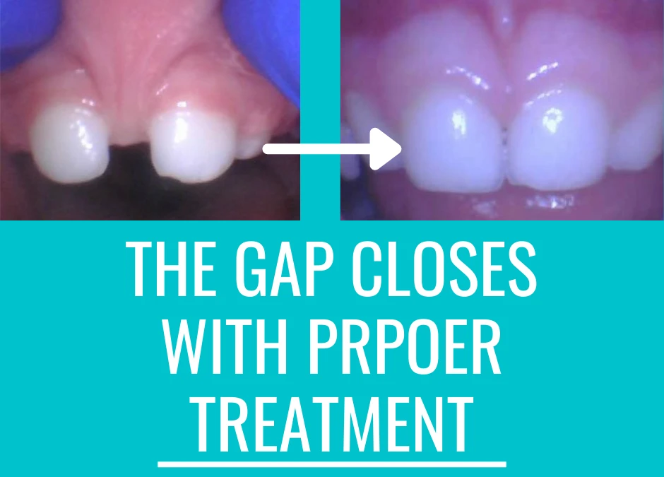 Does Treating a Lip Tie Help Close a Gap in the Teeth? And other common questions.
