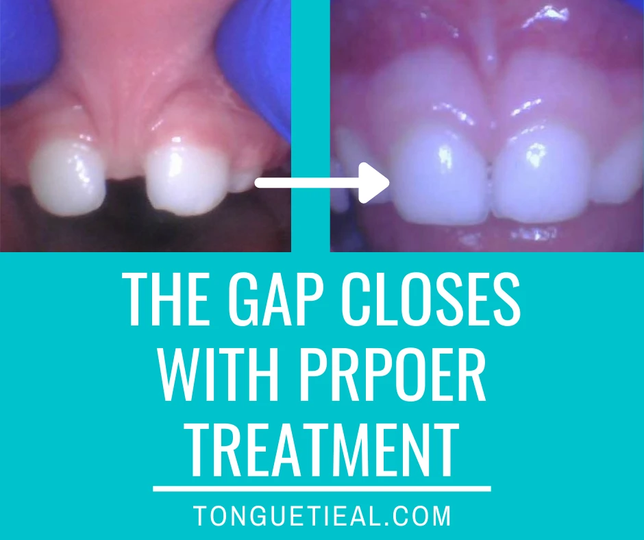 Gap Closure