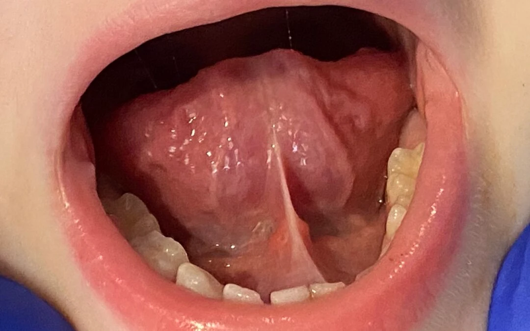 Do Tongue-Ties Go Away? Do They Stretch Out? 