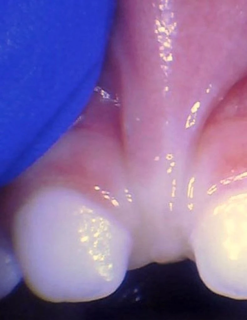 Release Tongue Ties Laser Technology Tongue Ties Child Lip Tie