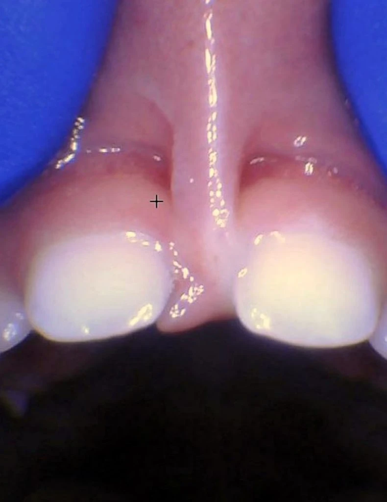 Release Tongue Ties Laser Technology Tongue Ties Child Lip Tie