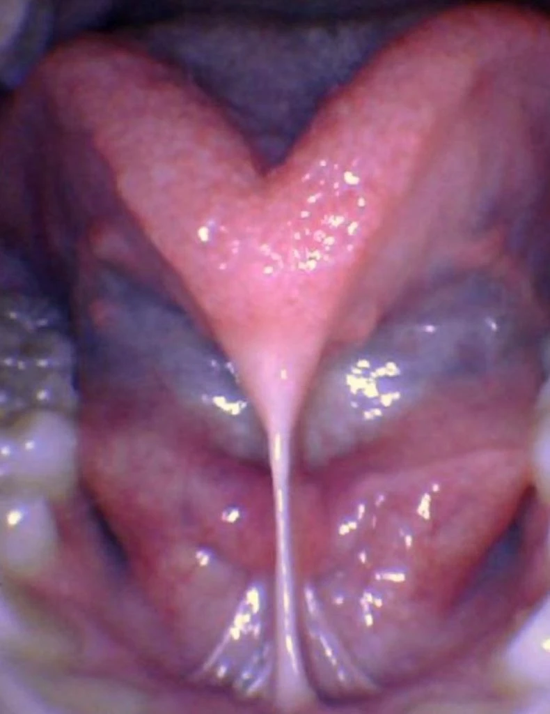 Release Tongue Ties Laser Technology Tongue Ties Child Tongue Tie