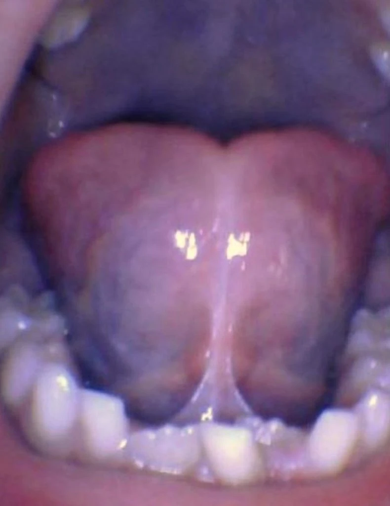 Release Tongue Ties Laser Technology Tongue Ties Child Tongue Tie