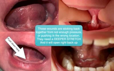 When Should I Re-Laser (Revise) a Tongue-Tie That Has Reattached?