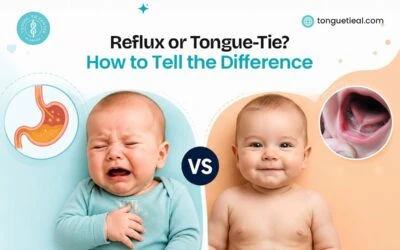 Reflux or Tongue-Tie? How to Tell the Difference