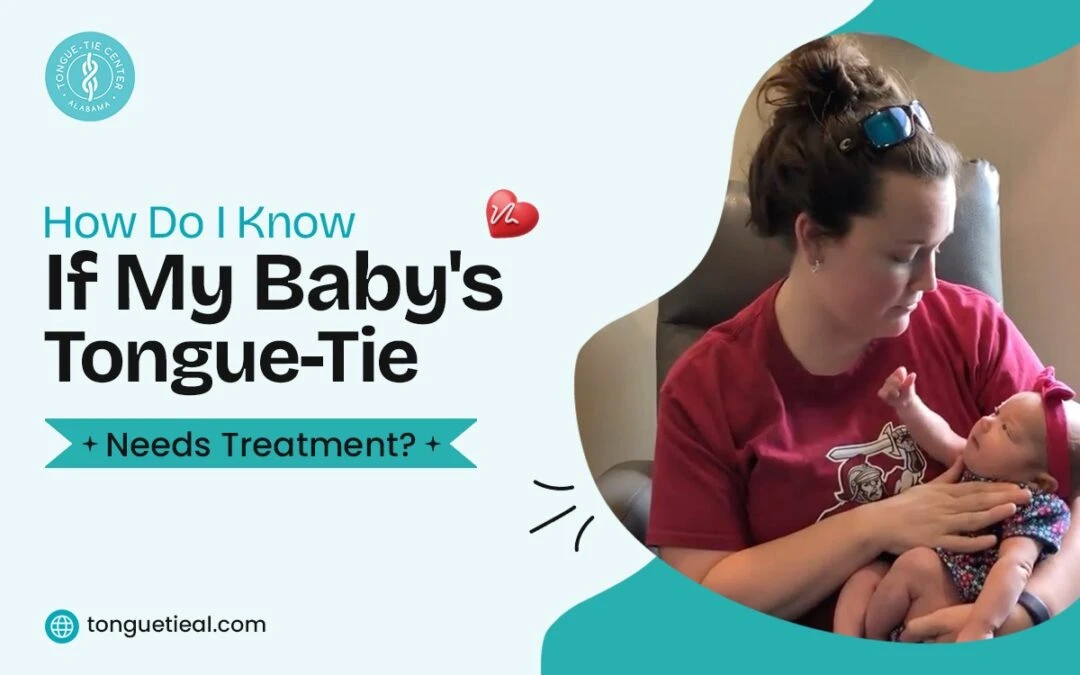How Do I Know If My Baby’s Tongue-Tie Needs Treatment?